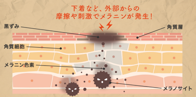 下着跡の黒ずみやアンダーのスレが消えない なくす方法は